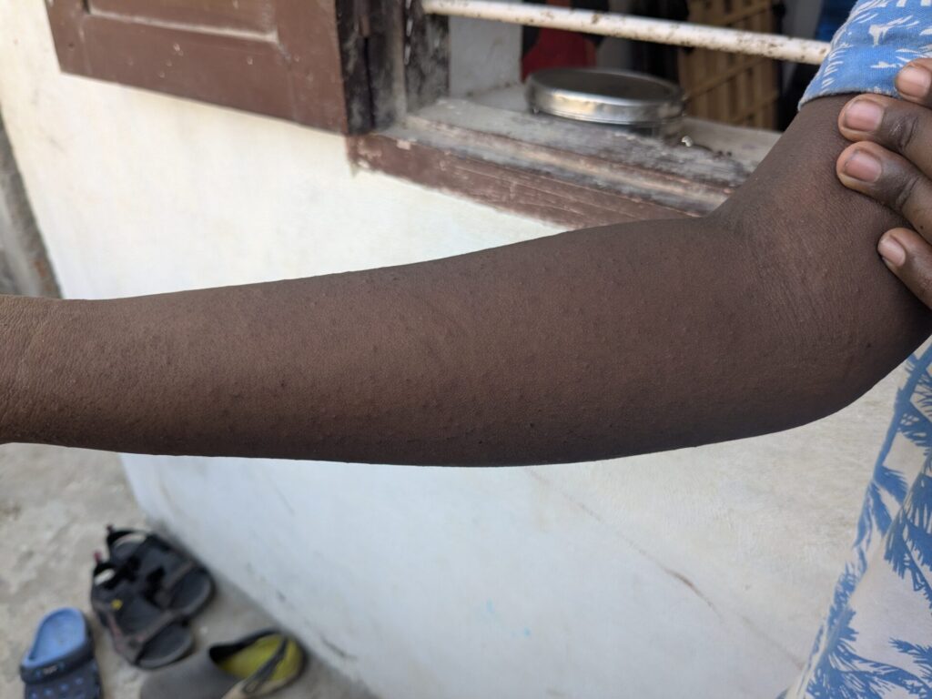 skin rashes due to heat
